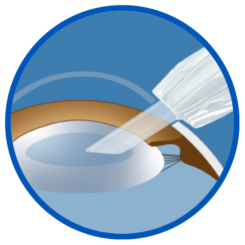 Delivery into capsular bag Insert shield: Default position