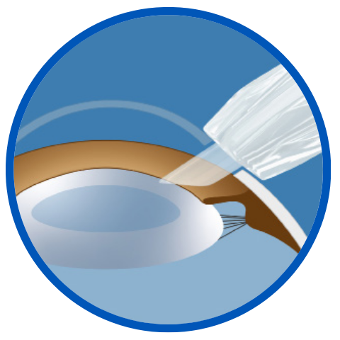 Delivery through incision wound tunnel Insert shield: Advanced position